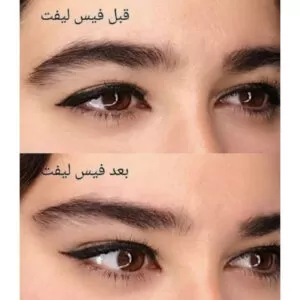 تاثیر کش لیفت و شقیقه