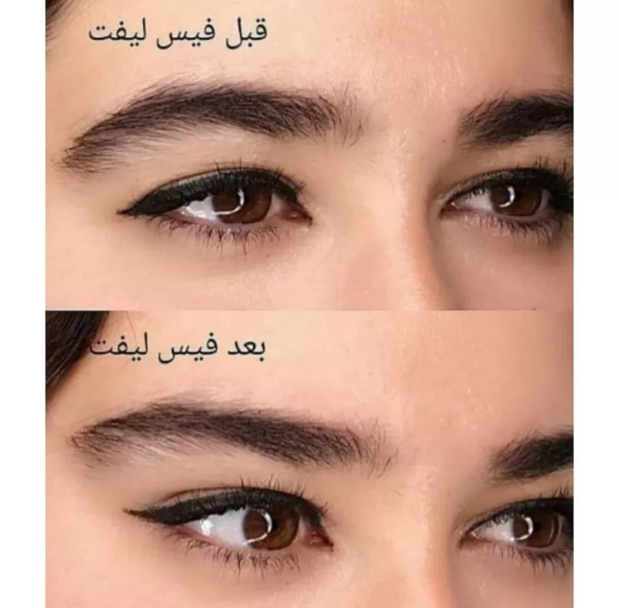 تاثیر کش لیفت و شقیقه