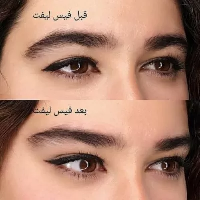 قبل و بعد استفاده از کش لیفت