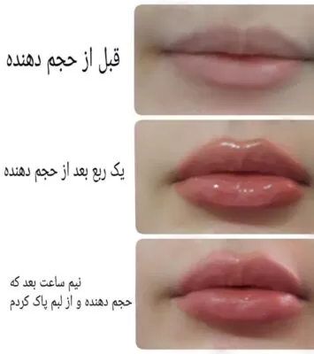 تست حجم دهنده لب فوری