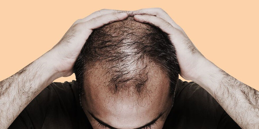 علت ریزش موی مردان و روش های پیشگیری و درمان آن
