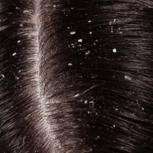تفاوت شوره سر و سپس در چیست