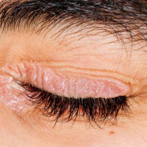 علت های خشکی پوست اطراف چشم چیه