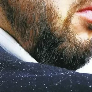 علت شوره ریش آقایان چیست
